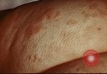 Image of penicillin United States USA, 1950, second 6 stock footage video 65675024756