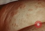 Image of penicillin United States USA, 1950, second 7 stock footage video 65675024756