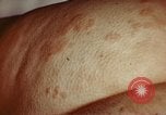 Image of penicillin United States USA, 1950, second 10 stock footage video 65675024756