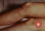Image of penicillin United States USA, 1950, second 11 stock footage video 65675024756