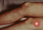 Image of penicillin United States USA, 1950, second 12 stock footage video 65675024756
