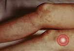 Image of penicillin United States USA, 1950, second 13 stock footage video 65675024756