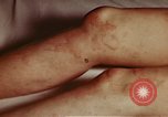 Image of penicillin United States USA, 1950, second 15 stock footage video 65675024756