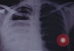 Standbild Penicillin United States USA, 1950, aus Sekunde 7 historischem Filmmaterial Videoclip 65675024762