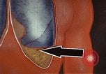 Standbild Penicillin United States USA, 1950, aus Sekunde 35 historischem Filmmaterial Videoclip 65675024762