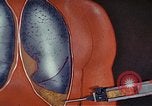 Standbild Penicillin United States USA, 1950, aus Sekunde 61 historischem Filmmaterial Videoclip 65675024762