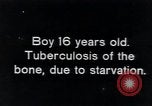 Image of Tuberculosis of bone Vienna Austria, 1923, second 1 stock footage video 65675027116