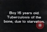 Image of Tuberculosis of bone Vienna Austria, 1923, second 3 stock footage video 65675027116