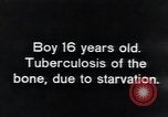 Image of Tuberculosis of bone Vienna Austria, 1923, second 4 stock footage video 65675027116