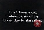 Image of Tuberculosis of bone Vienna Austria, 1923, second 5 stock footage video 65675027116