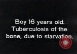 Image of Tuberculosis of bone Vienna Austria, 1923, second 6 stock footage video 65675027116