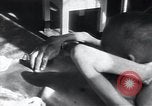 Image of Tuberculosis of bone Vienna Austria, 1923, second 26 stock footage video 65675027116