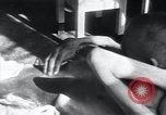 Image of Tuberculosis of bone Vienna Austria, 1923, second 27 stock footage video 65675027116