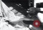 Image of Tuberculosis of bone Vienna Austria, 1923, second 33 stock footage video 65675027116