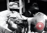 Image of Tuberculosis of bone Vienna Austria, 1923, second 38 stock footage video 65675027116
