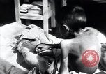 Image of Tuberculosis of bone Vienna Austria, 1923, second 39 stock footage video 65675027116