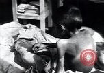 Image of Tuberculosis of bone Vienna Austria, 1923, second 45 stock footage video 65675027116