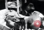 Image of Tuberculosis of bone Vienna Austria, 1923, second 50 stock footage video 65675027116