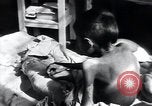 Image of Tuberculosis of bone Vienna Austria, 1923, second 51 stock footage video 65675027116