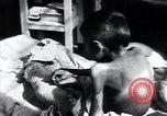 Image of Tuberculosis of bone Vienna Austria, 1923, second 52 stock footage video 65675027116