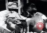 Image of Tuberculosis of bone Vienna Austria, 1923, second 53 stock footage video 65675027116