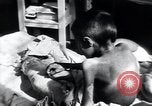 Image of Tuberculosis of bone Vienna Austria, 1923, second 55 stock footage video 65675027116