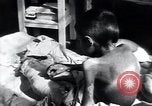 Image of Tuberculosis of bone Vienna Austria, 1923, second 57 stock footage video 65675027116