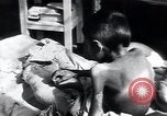 Image of Tuberculosis of bone Vienna Austria, 1923, second 58 stock footage video 65675027116