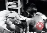 Image of Tuberculosis of bone Vienna Austria, 1923, second 59 stock footage video 65675027116