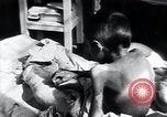 Image of Tuberculosis of bone Vienna Austria, 1923, second 60 stock footage video 65675027116