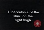 Image of Tuberculosis of skin Vienna Austria, 1923, second 1 stock footage video 65675027117