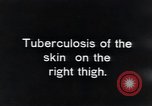 Image of Tuberculosis of skin Vienna Austria, 1923, second 3 stock footage video 65675027117