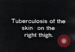 Image of Tuberculosis of skin Vienna Austria, 1923, second 5 stock footage video 65675027117