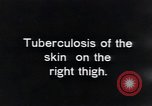 Image of Tuberculosis of skin Vienna Austria, 1923, second 6 stock footage video 65675027117