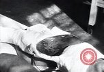 Image of Tuberculosis of skin Vienna Austria, 1923, second 7 stock footage video 65675027117