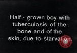 Image of Tuberculosis of bone and skin Vienna Austria, 1923, second 1 stock footage video 65675027118