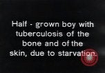 Image of Tuberculosis of bone and skin Vienna Austria, 1923, second 3 stock footage video 65675027118