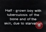 Image of Tuberculosis of bone and skin Vienna Austria, 1923, second 4 stock footage video 65675027118