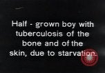 Image of Tuberculosis of bone and skin Vienna Austria, 1923, second 5 stock footage video 65675027118