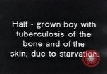 Image of Tuberculosis of bone and skin Vienna Austria, 1923, second 6 stock footage video 65675027118