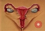Immagine di La gonorrea United States USA, 1964, secondo 33 filmato di repertorio 65675029104