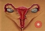 Immagine di La gonorrea United States USA, 1964, secondo 34 filmato di repertorio 65675029104