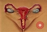 Immagine di La gonorrea United States USA, 1964, secondo 35 filmato di repertorio 65675029104