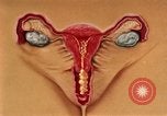 Immagine di La gonorrea United States USA, 1964, secondo 36 filmato di repertorio 65675029104