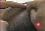 Image of cure for baldness in men United States USA, 1990, second 47 stock footage video 65675036379