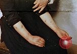 Image of Japanese nurse with atomic bomb scars Hiroshima Japan, 1945, second 1 stock footage video 65675042171