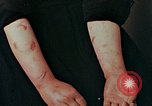 Image of Japanese nurse with atomic bomb scars Hiroshima Japan, 1945, second 23 stock footage video 65675042171