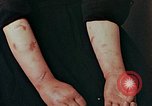 Image of Japanese nurse with atomic bomb scars Hiroshima Japan, 1945, second 24 stock footage video 65675042171