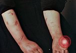 Image of Japanese nurse with atomic bomb scars Hiroshima Japan, 1945, second 25 stock footage video 65675042171