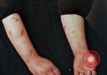 Image of Japanese nurse with atomic bomb scars Hiroshima Japan, 1945, second 26 stock footage video 65675042171
